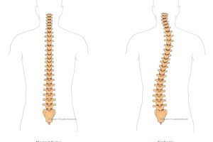 scoliosis